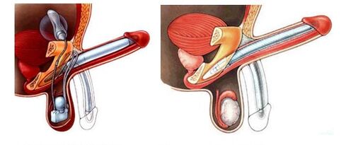 Penile prosthesis with an inflatable (left) and plastic (right) prosthesis