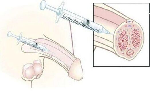 Injust hyaluronic acid injections