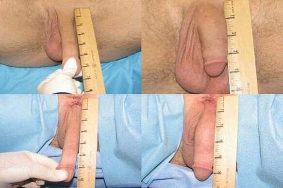 penis measurement after enlargement operation