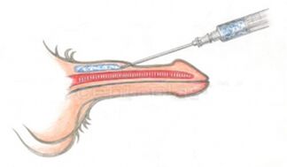 Volumizing injection of hyaluronic acid into the penis